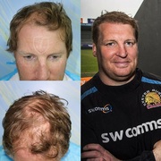 Capital Hair Restoration - Hair Transplant Reading